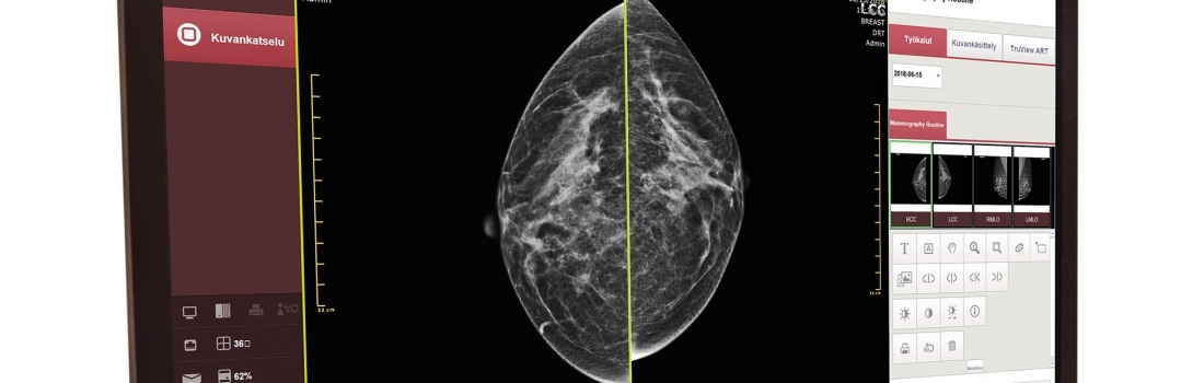 Innomentarium’s digital solution for mammography imaging has been clinically validated – results are extremely good
